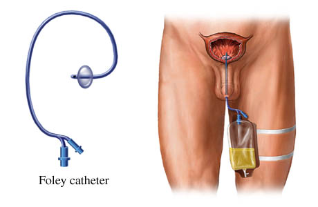 Illustration of a Foley catheter.