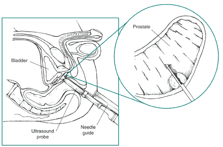 Cross-section diagram of transrectal prostate biopsy with ultrasound probe inserted into the rectum.  A biopsy needle extends from the probe.  An inset shows larger view of the needle tip in the prostate.