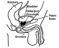  male urinary tract showing how an enlarged prostate can squeeze the urethra and block urine flow.