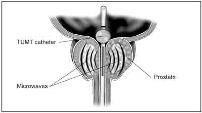 In TUMT, microwaves heat part of the prostate.